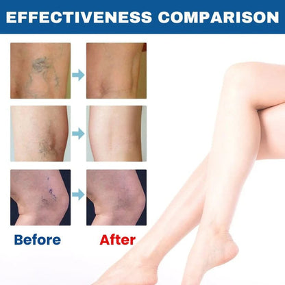 BioEquis Varicose Vein Relief Spray